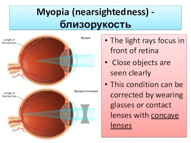 Myopia (nearsightedness) - близорукость The light rays focus in front