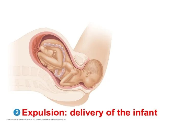 Expulsion: delivery of the infant 2