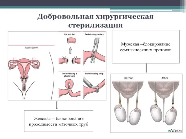 Добровольная хирургическая стерилизация Женская – блокирование проходимости маточных труб Мужская –блокирование семявыносящих протоков