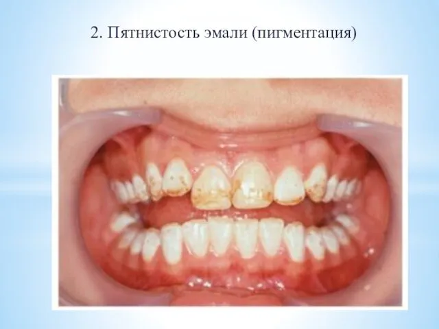 2. Пятнистость эмали (пигментация)