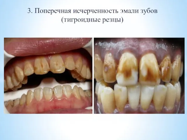 3. Поперечная исчерченность эмали зубов (тигроидные резцы)