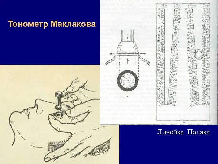 Тонометр Маклакова Линейка Поляка