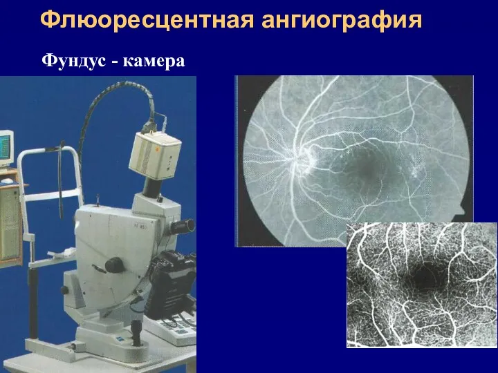 Флюоресцентная ангиография Фундус - камера