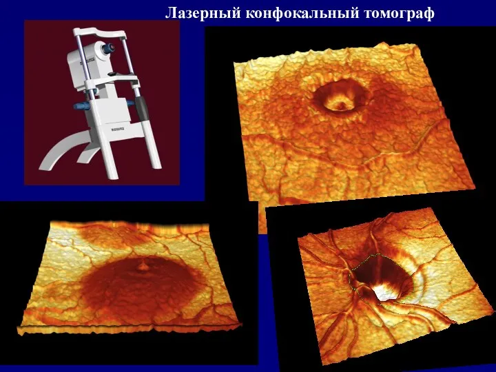 Лазерный конфокальный томограф