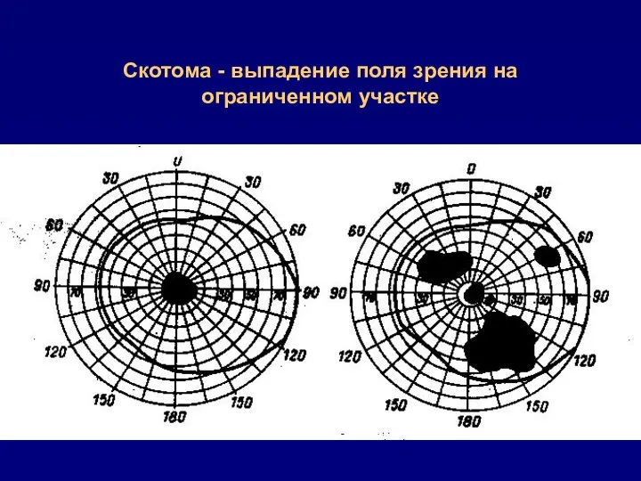 Скотома - выпадение поля зрения на ограниченном участке