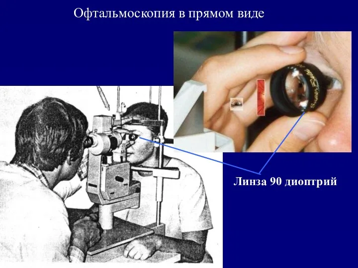Линза 90 диоптрий Офтальмоскопия в прямом виде