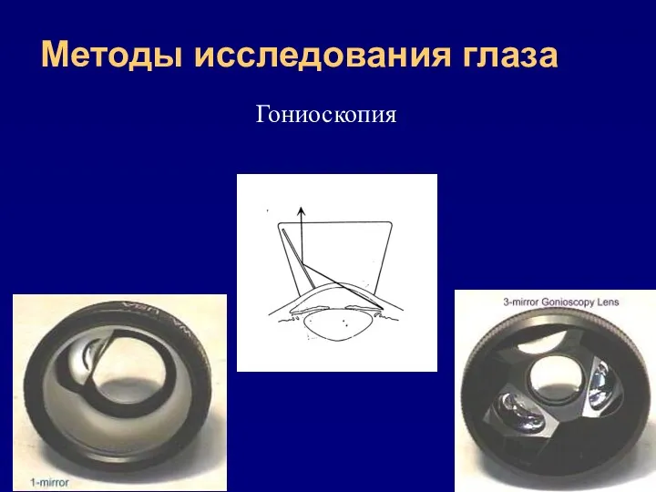 Методы исследования глаза Гониоскопия