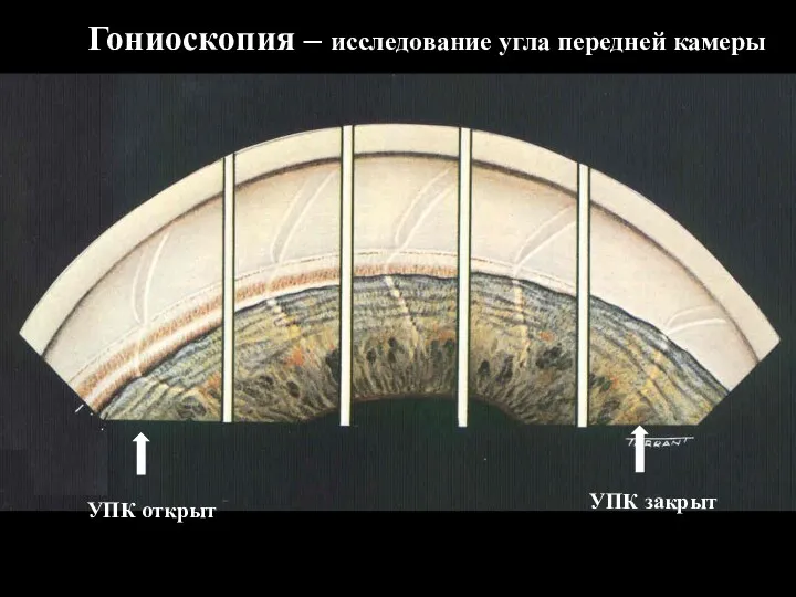 Гониоскопия – исследование угла передней камеры УПК открыт УПК закрыт