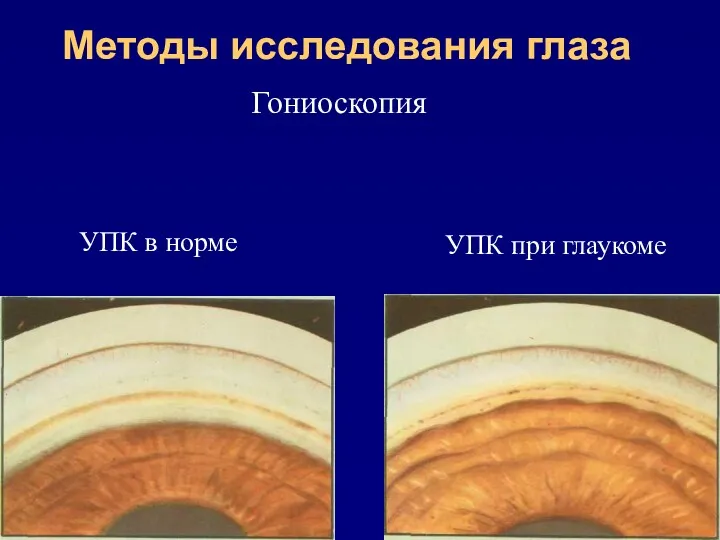 Методы исследования глаза Гониоскопия УПК в норме УПК при глаукоме