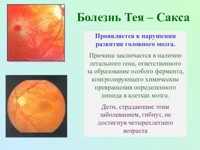 Болезнь Тея – Сакса Проявляется в нарушении развития головного мозга.