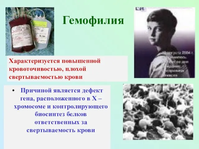 Гемофилия Причиной является дефект гена, расположенного в Х – хромосоме