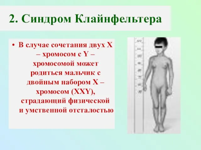 2. Синдром Клайнфельтера В случае сочетания двух Х – хромосом