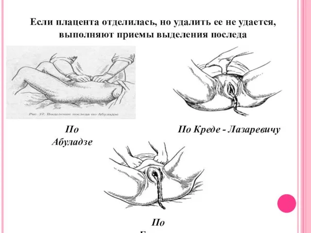 Если плацента отделилась, но удалить ее не удается, выполняют приемы