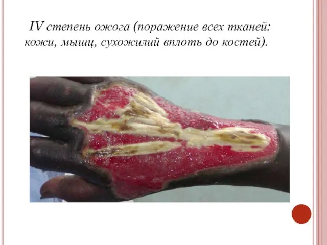 IV степень ожога (поражение всех тканей: кожи, мышц, сухожилий вплоть до костей).