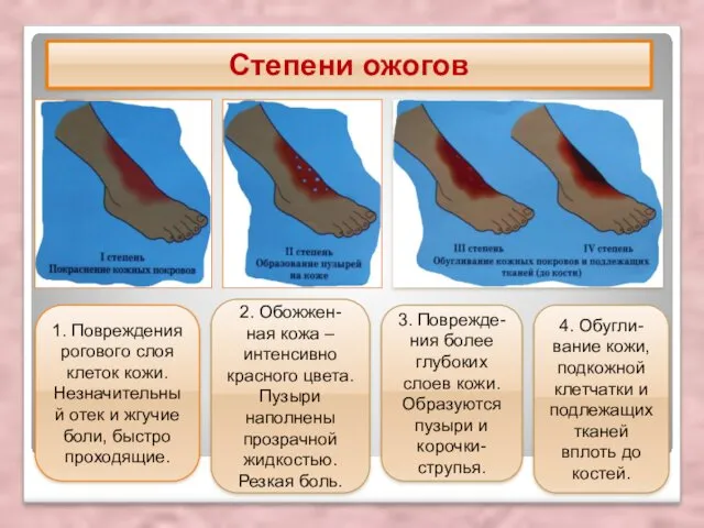 Степени ожогов 1. Повреждения рогового слоя клеток кожи. Незначительный отек