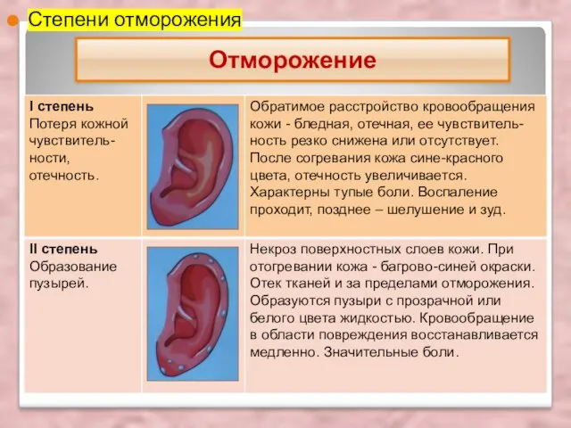 Отморожение Степени отморожения