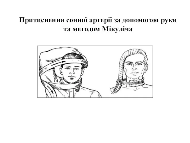 Притиснення сонної артерії за допомогою руки та методом Мікуліча