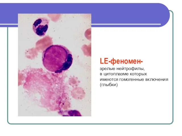 LE-феномен- зрелые нейтрофилы, в цитоплазме которых имеются гомогенные включения (глыбки)