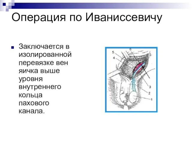 Операция по Иваниссевичу Заключается в изолированной перевязке вен яичка выше уровня внутреннего кольца пахового канала.