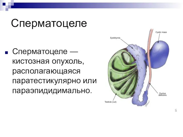 Сперматоцеле Сперматоцеле — кистозная опухоль, располагающаяся паратестикулярно или параэпидидимально.