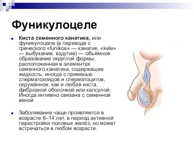 Фуникулоцеле Киста семенного канатика, или фуникулоцеле (в переводе с греческого