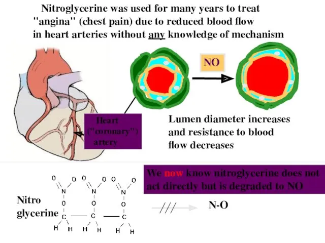 Nitroglycerine was used for many years to treat "angina" (chest