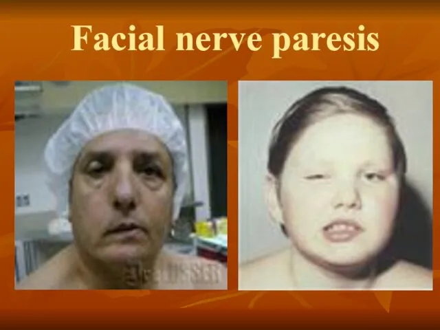 Facial nerve paresis