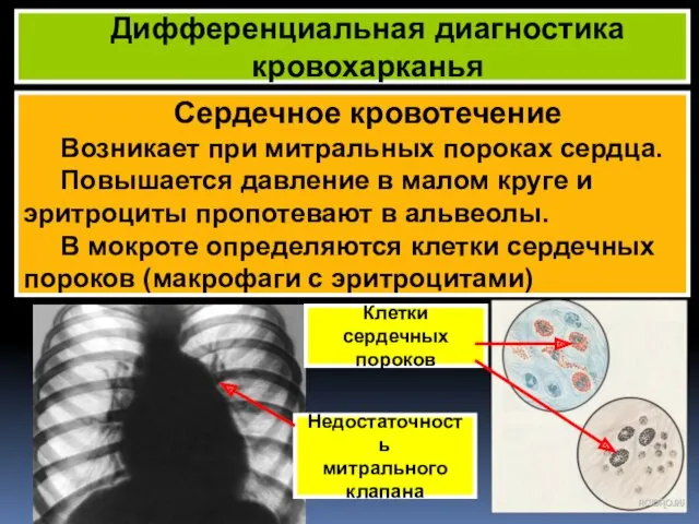 Сердечное кровотечение Возникает при митральных пороках сердца. Повышается давление в