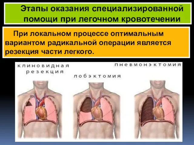 При локальном процессе оптимальным вариантом радикальной операции является резекция части легкого. Этапы оказания