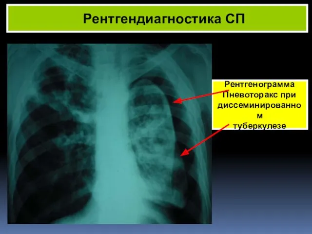 Рентгендиагностика СП Рентгенограмма Пневоторакс при диссеминированном туберкулезе