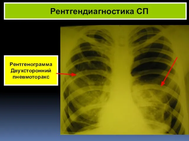 Рентгендиагностика СП Рентгенограмма Двухсторонний пневмоторакс