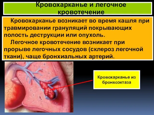 Кровохарканье возникает во время кашля при травмировании грануляций покрывающих полость деструкции или опухоль.