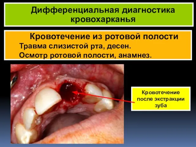 Кровотечение из ротовой полости Травма слизистой рта, десен. Осмотр ротовой полости, анамнез. Дифференциальная