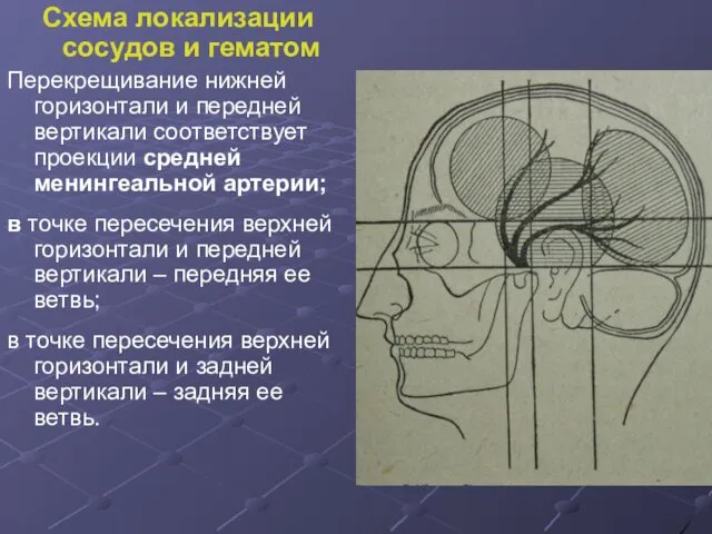 Схема локализации сосудов и гематом Перекрещивание нижней горизонтали и передней вертикали соответствует проекции