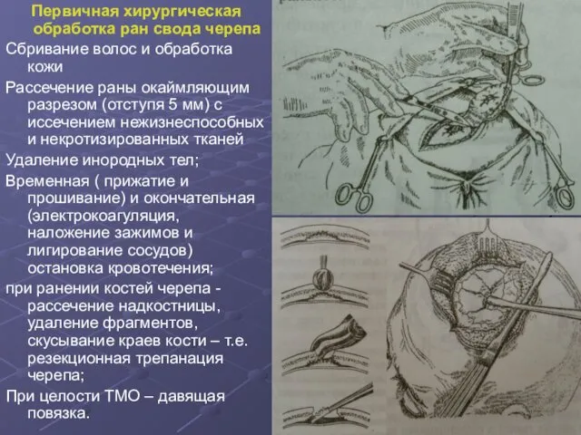 Первичная хирургическая обработка ран свода черепа Сбривание волос и обработка кожи Рассечение раны