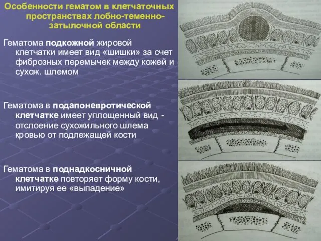 Особенности гематом в клетчаточных пространствах лобно-теменно-затылочной области Гематома подкожной жировой клетчатки имеет вид