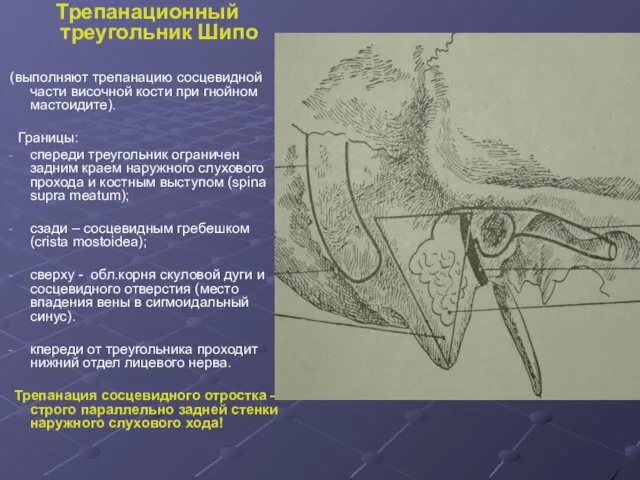 Трепанационный треугольник Шипо (выполняют трепанацию сосцевидной части височной кости при гнойном мастоидите). Границы: