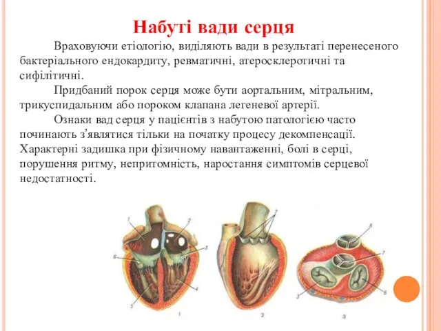 Набуті вади серця Враховуючи етіологію, виділяють вади в результаті перенесеного