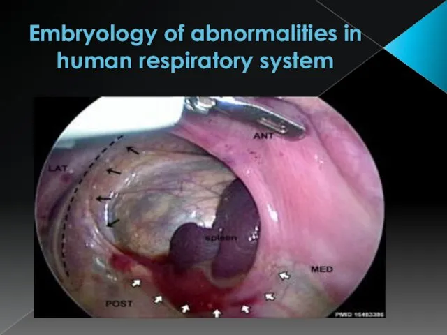 Embryology of abnormalities in human respiratory system