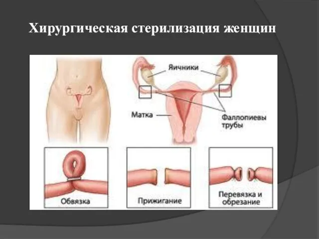 Хирургическая стерилизация женщин