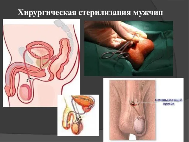 Хирургическая стерилизация мужчин