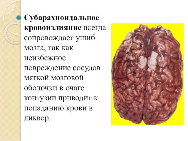 Субарахноидальное кровоизлияние всегда сопровождает ушиб мозга, так как неизбежное повреждение