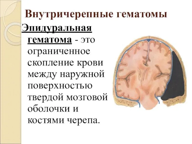 Внутричерепные гематомы Эпидуральная гематома - это ограниченное скопление крови между