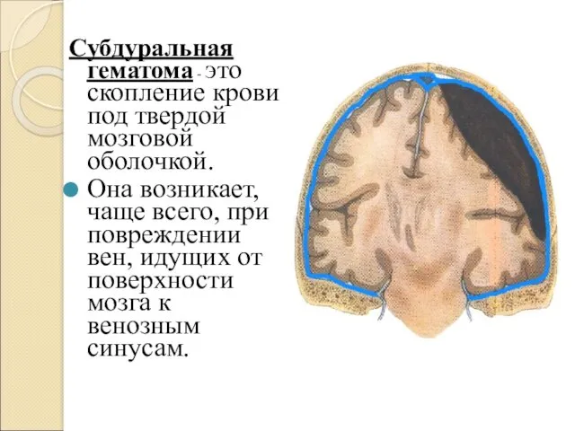 Субдуральная гематома - это скопление крови под твердой мозговой оболочкой.