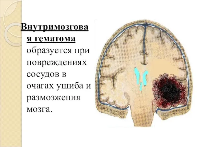 Внутримозговая гематома образуется при повреждениях сосудов в очагах ушиба и размозжения мозга.