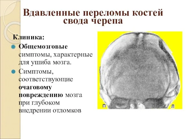 Вдавленные переломы костей свода черепа Клиника: Общемозговые симптомы, характерные для