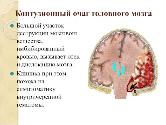 Контузионный очаг головного мозга Большой участок деструкции мозгового вещества, имбибированный