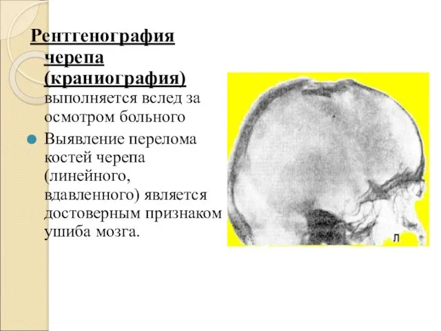 Рентгенография черепа (краниография) выполняется вслед за осмотром больного Выявление перелома