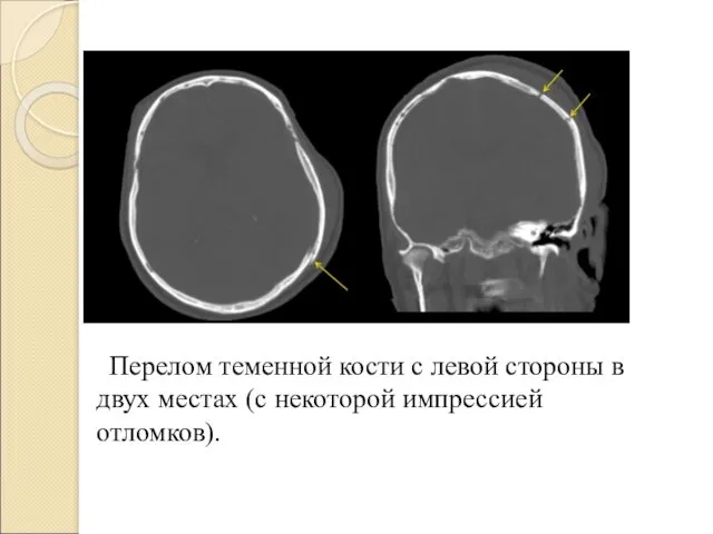 Перелом теменной кости с левой стороны в двух местах (с некоторой импрессией отломков).