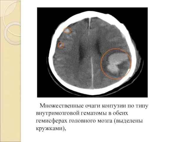 Множественные очаги контузии по типу внутримозговой гематомы в обеих гемисферах головного мозга (выделены кружками),